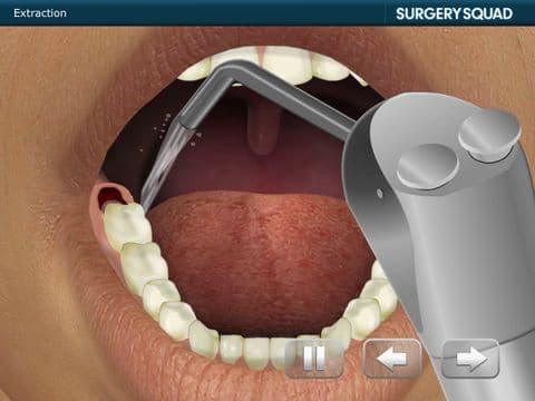 Surgery Squads Wisdom Tooth Extraction screenshot 5
