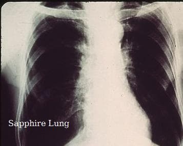 Sapphire Lung