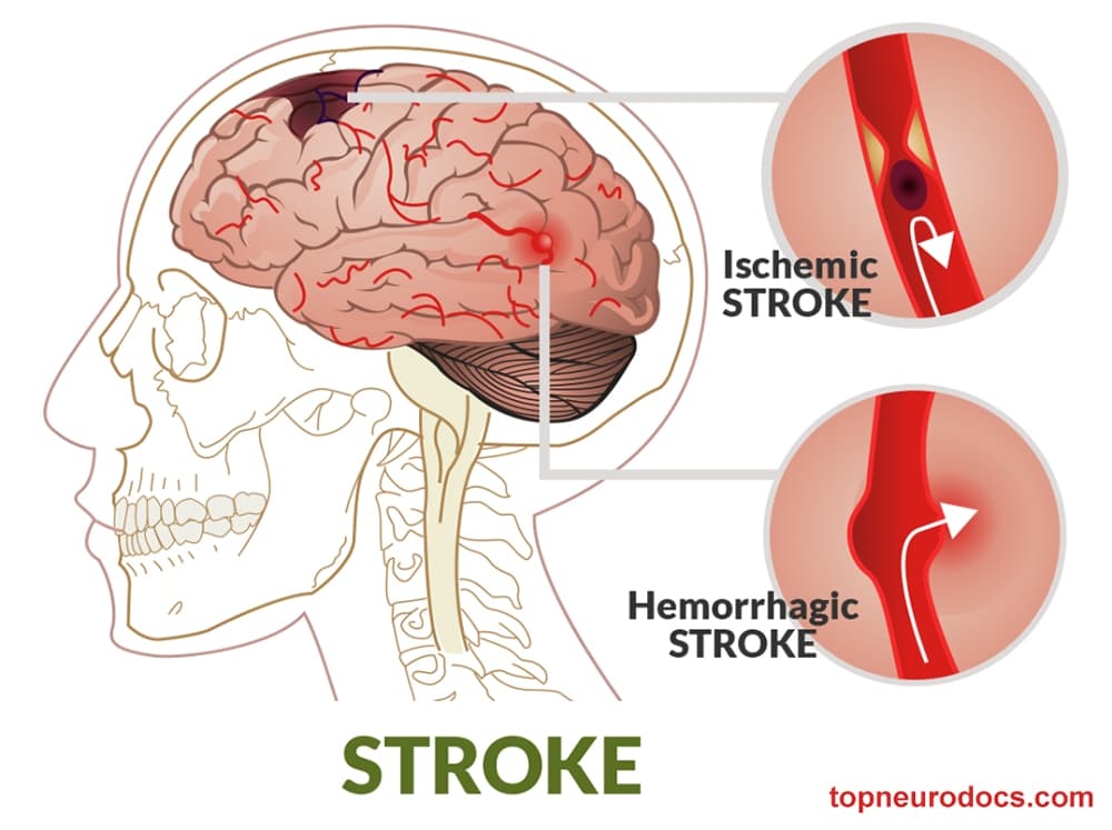 Acute Stroke: Complete Algorithm