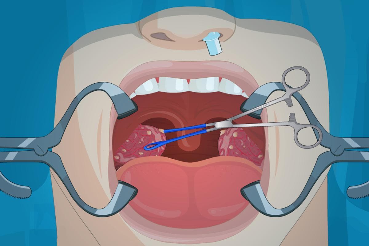 Operate Now: Tonsil Surgery screenshot 4