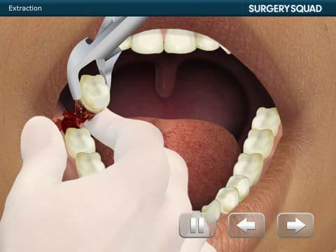 Surgery Squads Wisdom Tooth Extraction screenshot 4